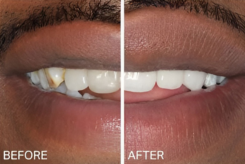 Dental-Crowns-Before-&-After